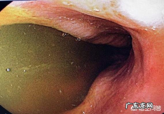 胆汁反流是什么原因导致的?