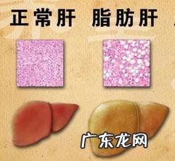 体检检出脂肪肝,可以跑步把脂肪肝“跑”掉吗