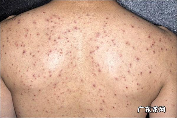 后背长了很多痘痘和黑头,能用粉刺针挤掉吗?如何处理?