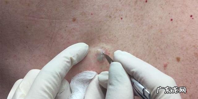 后背长了很多痘痘和黑头,能用粉刺针挤掉吗?如何处理?