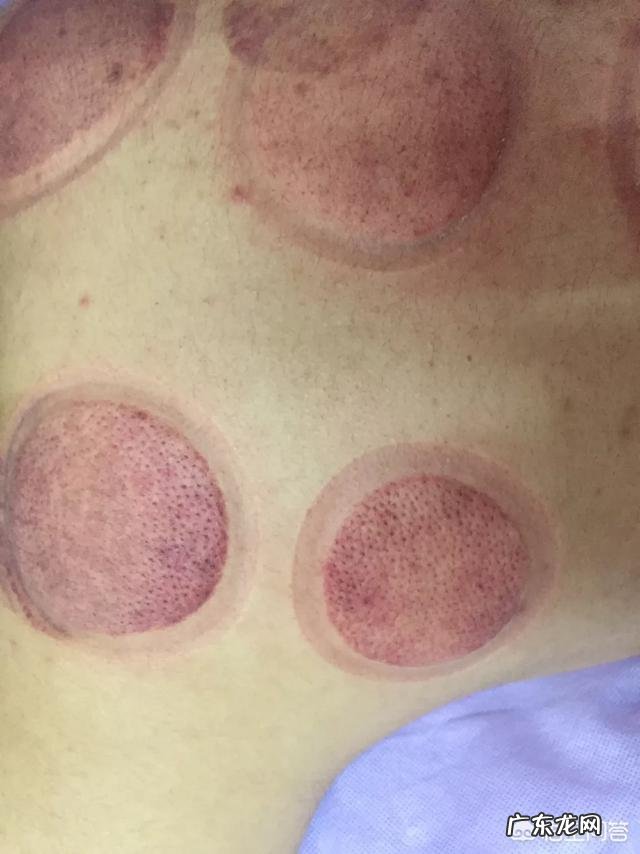 拔罐后长水泡怎么办 拔罐真的有用吗?拔罐后长水泡究竟是什么问题?