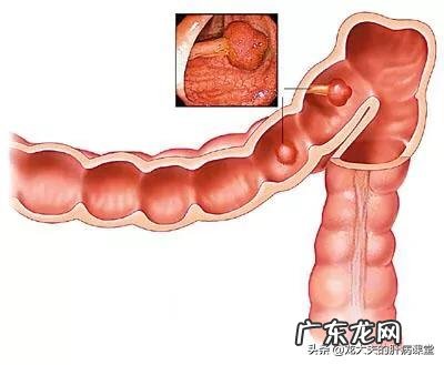 夜晚经常排便正常吗？原因是什么？