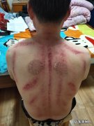 “刮痧”刮对了zhi病，刮错了要命！真的确定你懂刮痧吗？
