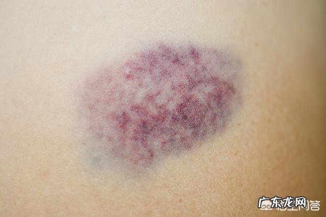 林允双腿淤青，真的是因为减肥节食过度导致血小板低吗？