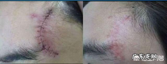 外用疤痕药真能祛疤吗?原理是什么?