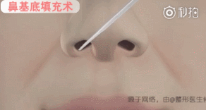 请问有什么方法除法令纹，哪种有效时间长性价比高，谢谢？