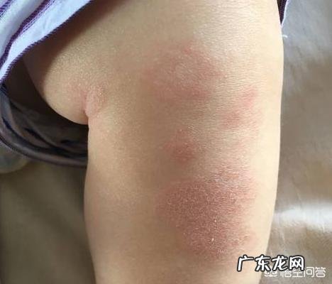 婴儿湿疹退后皮肤会恢复正常吗