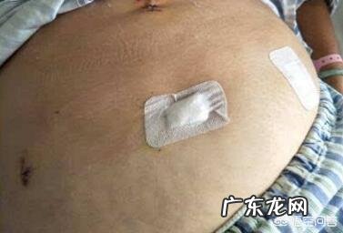 合肥420斤男子做切胃减重手术2年200斤，你怎么看