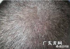 牛皮癣，白癜风，银屑病，脂溢性皮炎，相同处与不同之处是什么