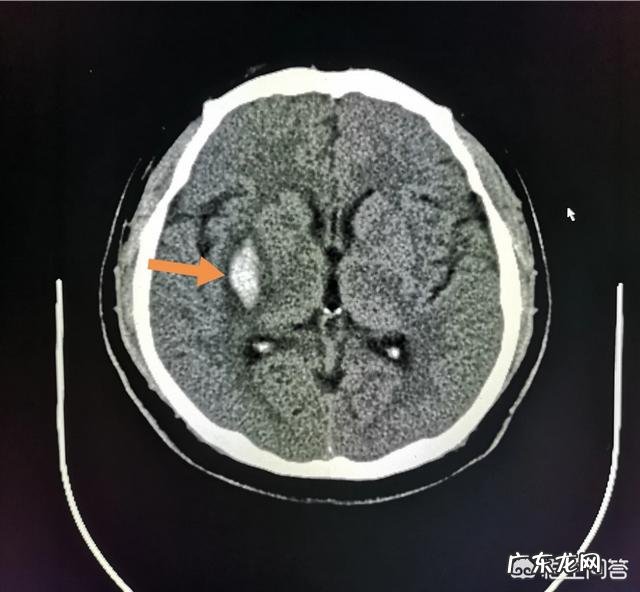 脑梗的“祸根”除了吸烟和多酒,还有哪些也会造成?