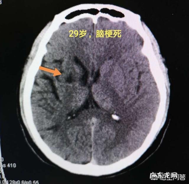 脑梗的“祸根”除了吸烟和多酒,还有哪些也会造成?