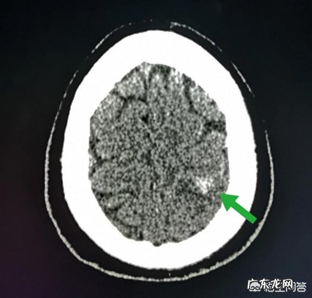 脑梗的“祸根”除了吸烟和多酒,还有哪些也会造成?