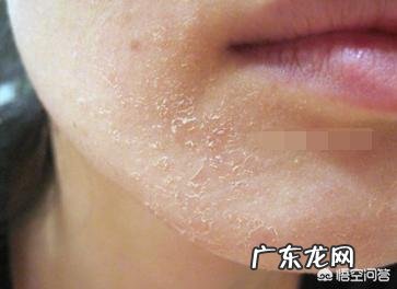 激素脸修复期间脱皮是好是坏？激素脸期间脱皮要注意什么？