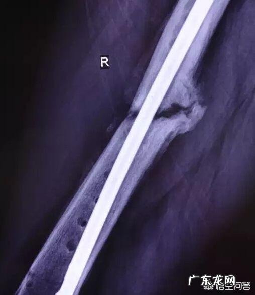 年轻时做近视激光手术,老了容易得白内障吗