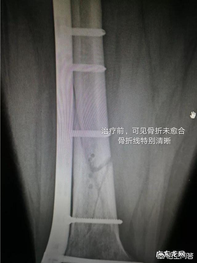 年轻时做近视激光手术,老了容易得白内障吗