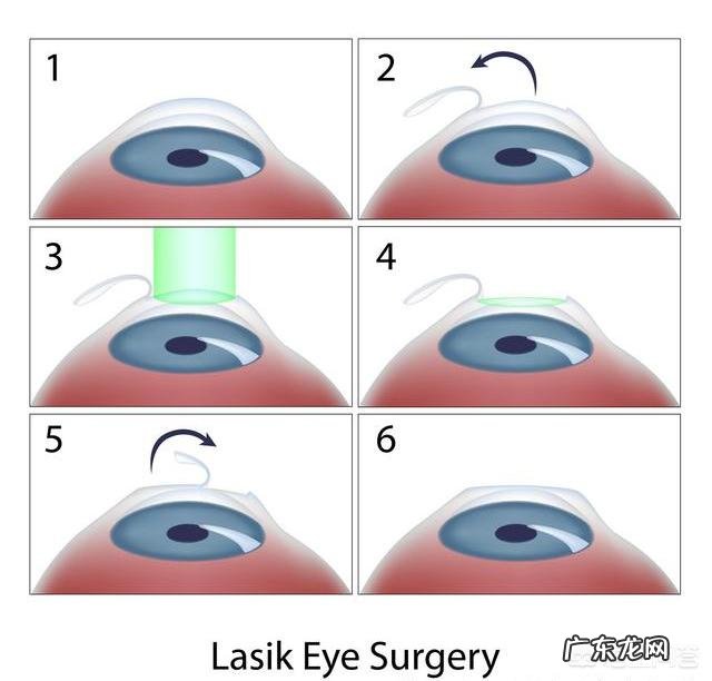 年轻时做近视激光手术,老了容易得白内障吗