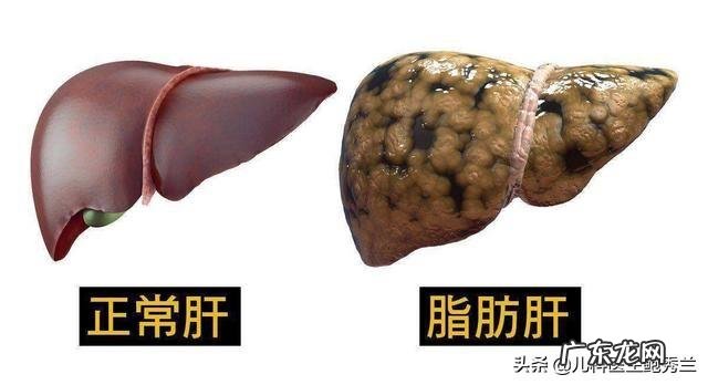 甘油三酯超标，都是哪些因素造成的？如何把甘油三酯降下去？