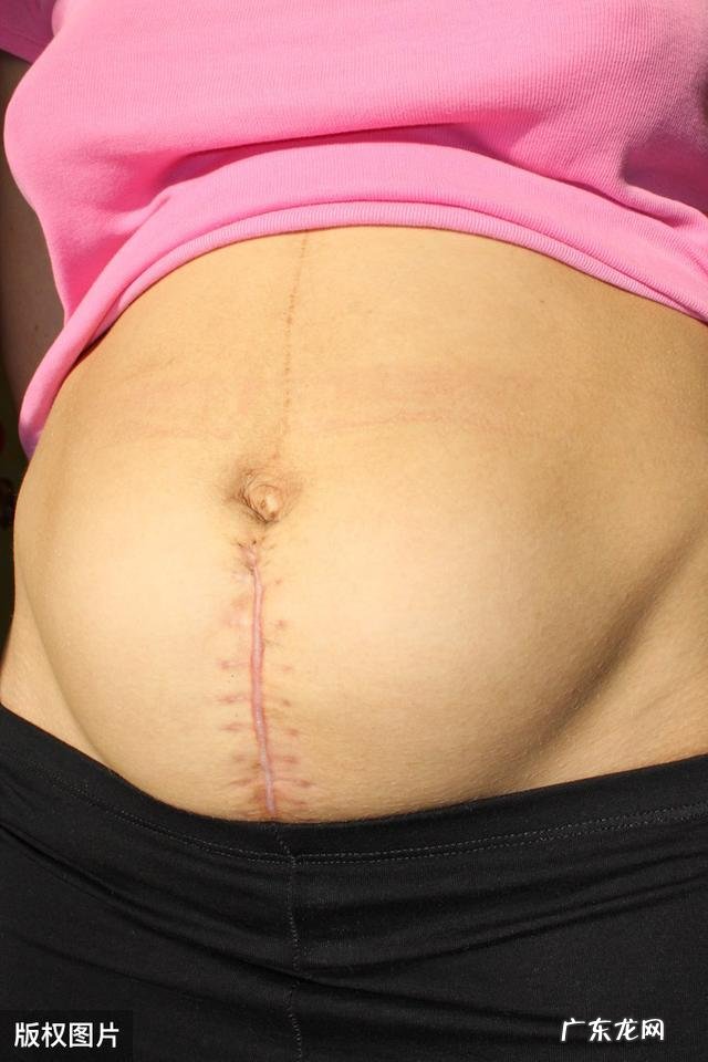 剖腹产的妈妈产后需不需要束腹带?