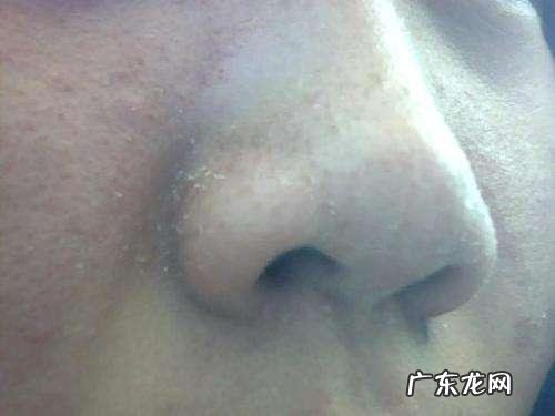 有些人总是在早上起床时发现脸上长痘,是什么原因?