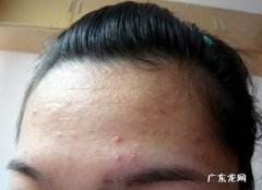 有些人总是在早上起床时发现脸上长痘，是什么原因？