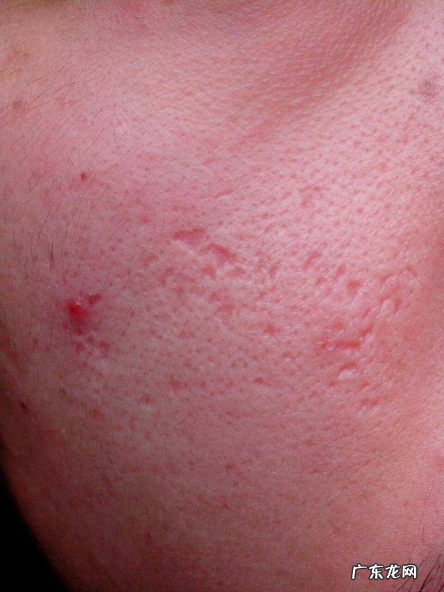 有些人总是在早上起床时发现脸上长痘,是什么原因?