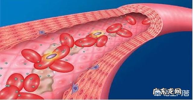 甘油三酯高是高血脂吗？怎么降下来？