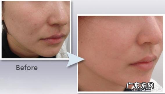 你觉得做光子嫩肤怎么样?大概需要多少钱?