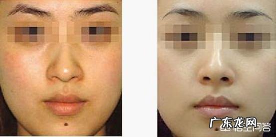 你觉得做光子嫩肤怎么样?大概需要多少钱?