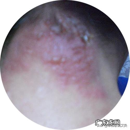 身上起小米粒状疙瘩怎么办？