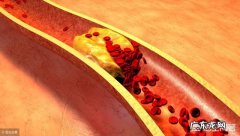 甘油三酯不高，胆固醇高，说明什么？