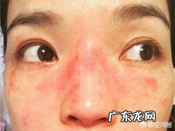 热水敷脸然后脸都红了，请问对皮肤有伤害吗