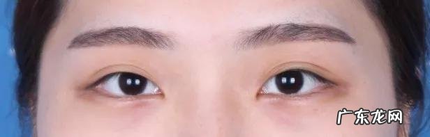 00后要割双眼皮 00后瞒着家人割双眼皮