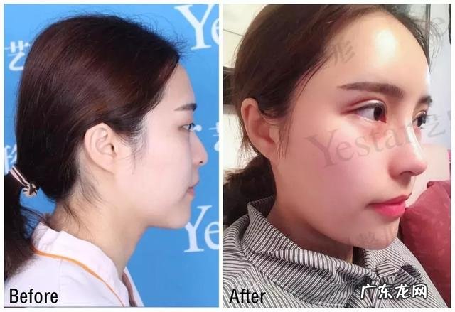 00后要割双眼皮 00后瞒着家人割双眼皮