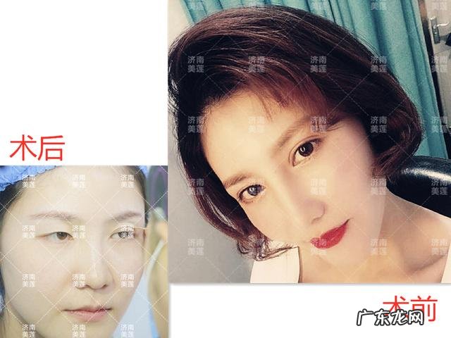 割双眼皮之后真的能变漂亮 割了双眼皮真的变好看了吗
