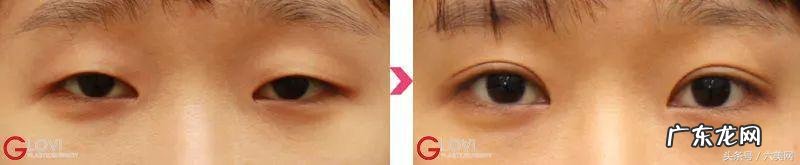 双眼皮全切开眼角恢复过程记录 双眼皮手术开眼角恢复过程图