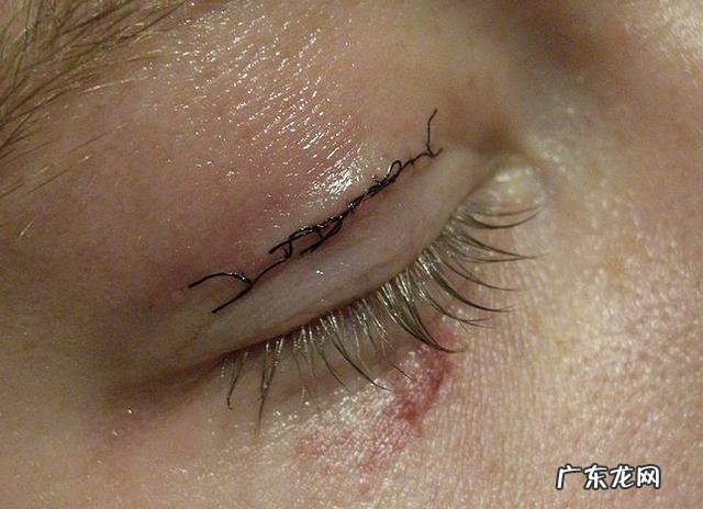 双眼皮手术各种利弊 双眼皮手术方式及其优缺点