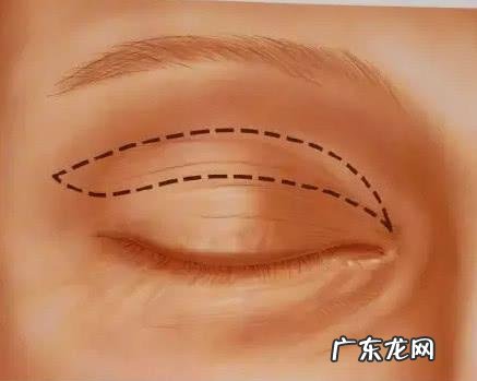 韩式三点双眼皮手术模拟 韩式三点双眼皮手术过程
