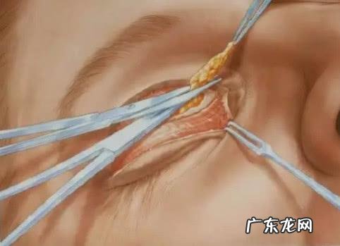 韩式三点双眼皮手术模拟 韩式三点双眼皮手术过程