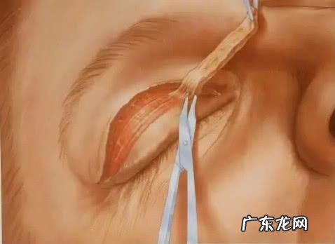 韩式三点双眼皮手术模拟 韩式三点双眼皮手术过程