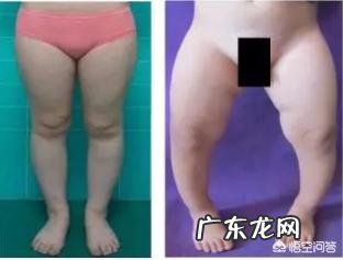 如果宝宝o 型腿怎么办 宝宝有点O型腿,怎么办?