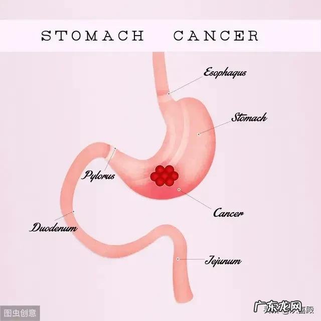 幽门螺旋杆菌有多可怕,会不会导致胃癌呢