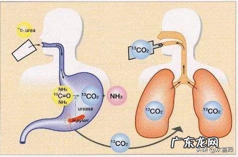 幽门螺旋杆菌有多可怕,会不会导致胃癌呢
