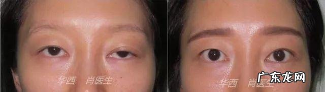 割双眼皮图片大全 割个双眼皮多少钱