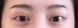 割双眼皮图片大全 割个双眼皮多少钱