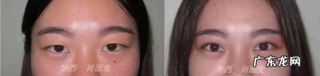 割双眼皮图片大全 割个双眼皮多少钱