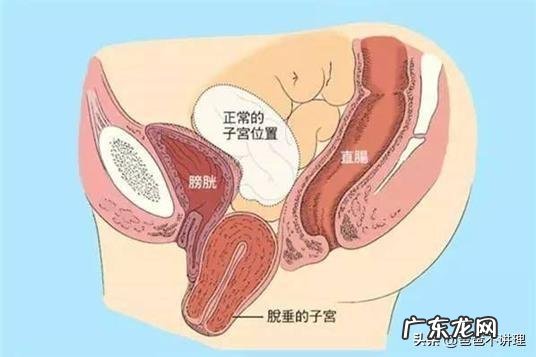 哺乳期的妈妈如何防止子宫下垂,臀部变宽?收腹能达到效果吗?