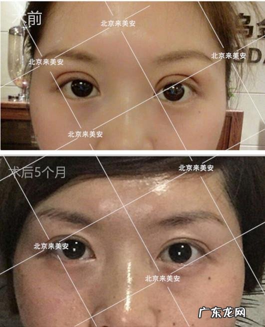做双眼皮手术全过程真人 做双眼皮手术要了解哪些