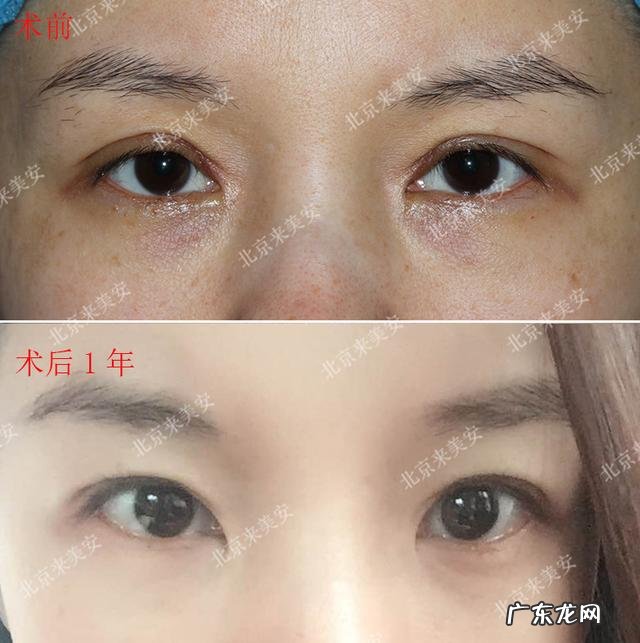 做双眼皮手术全过程真人 做双眼皮手术要了解哪些