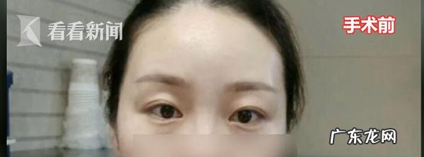 杨天荣双眼皮整形案例 只做双眼皮的整形医院