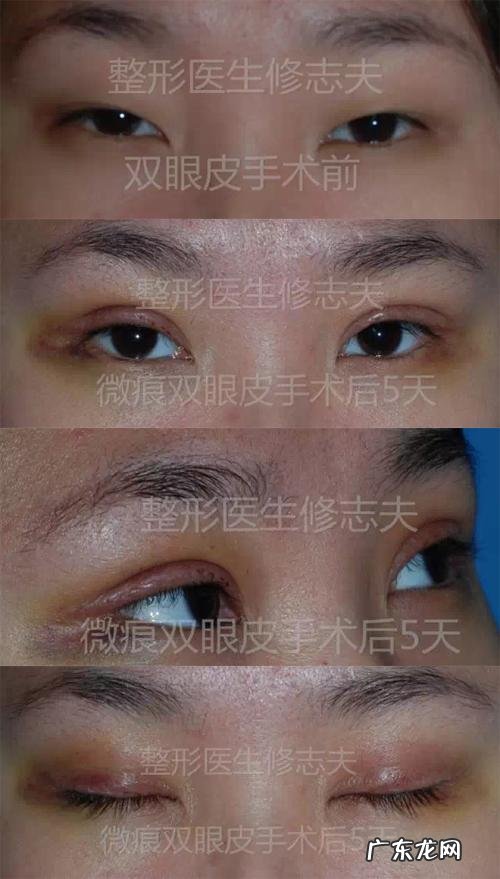 开扇形双眼皮修复案例照片 全切开扇形双眼皮案例照片